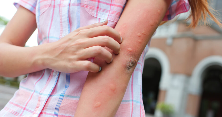 Stings and Things: First-Aid Tips for Summer Bites & Stings in Savannah, GA