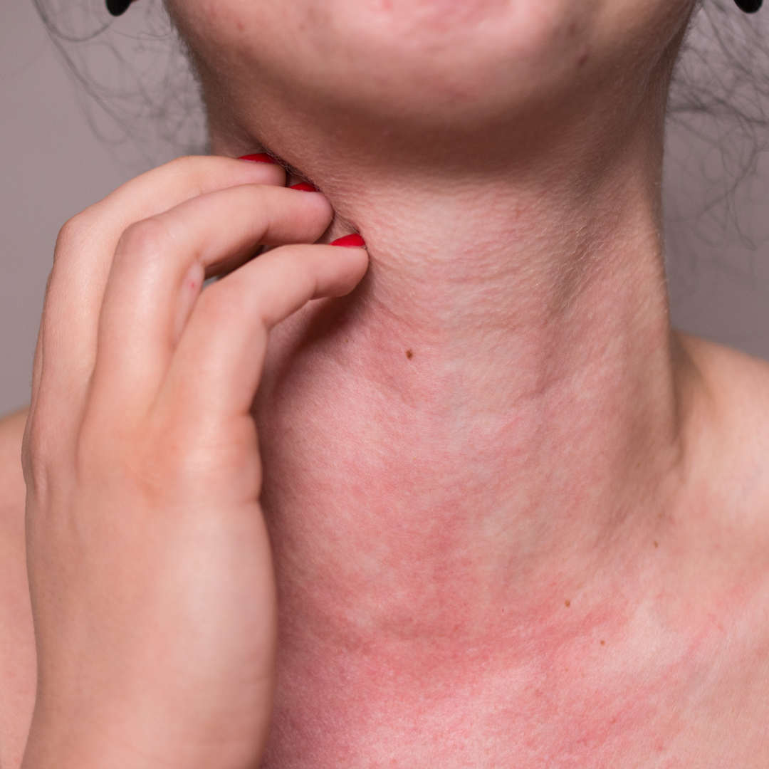 food allergies Savannah